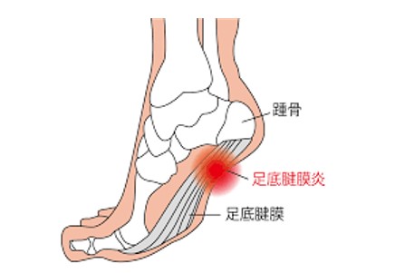 かかとの痛み・足底筋膜炎
